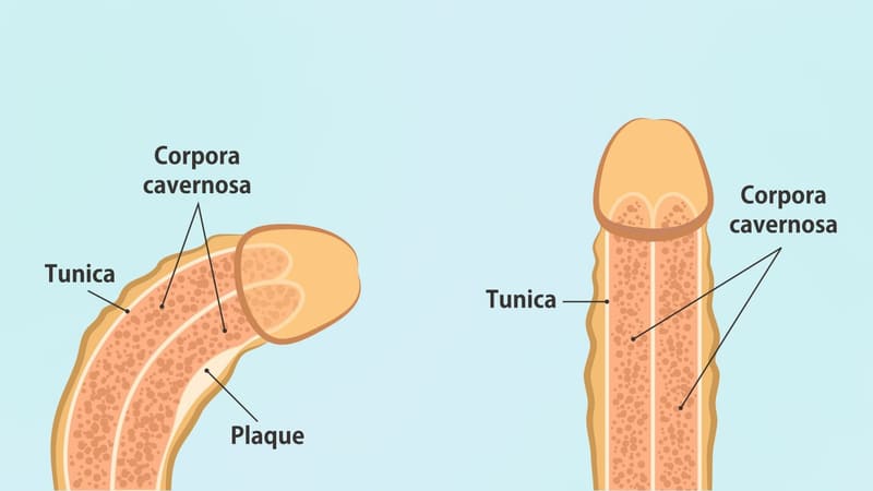 Bệnh Peyronie là gì? Những vấn đề cần biết về bệnh Peyronie