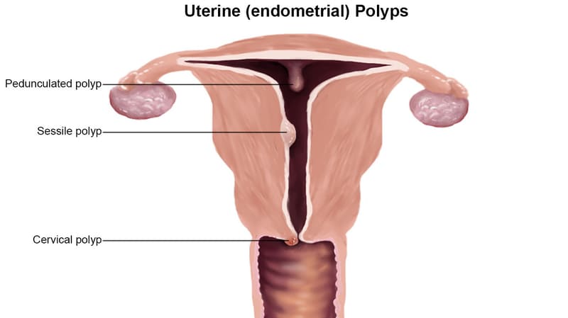 Polyp tử cung là gì? Những vấn đề cần biết về polyp tử cung